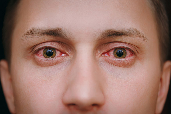 Man with red, sore eyes due to conjunctivitis