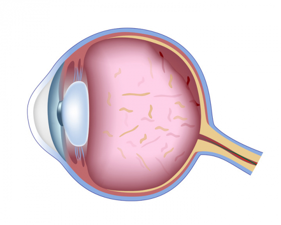 Diagram of floaters in the eye