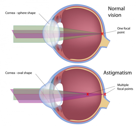 Diagram of astigmatism